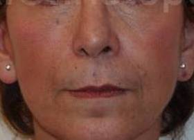 Before-Face Lifting