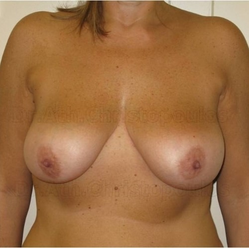 Before-Ανόρθωση στήθους