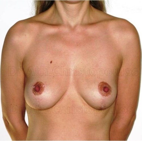 After-Ανόρθωση στήθους