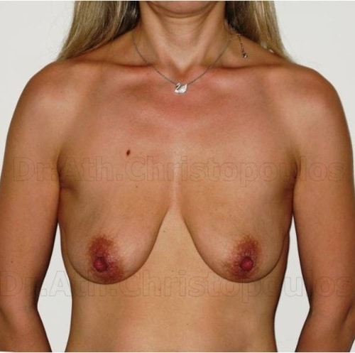 Before-Ανόρθωση στήθους