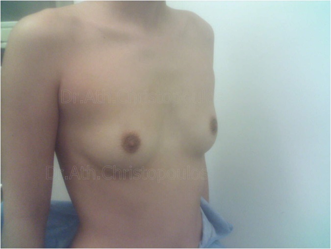 Before-Αυξητική στήθους