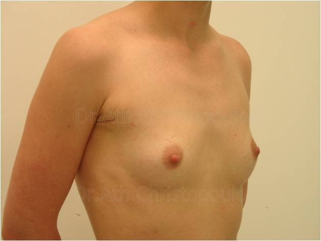 Before-Αυξητική στήθους