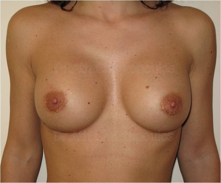 After-Αυξητική στήθους
