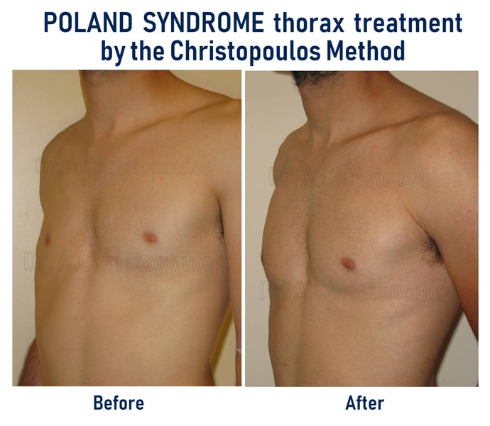 Poland Syndrome assymetry breast Christopoulos method
