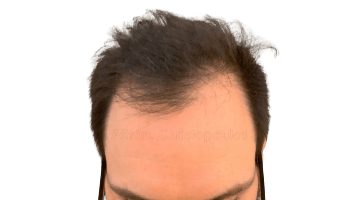 Before- Μεταμόσχευση μαλλιών