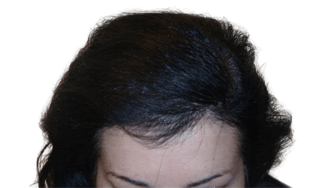 After-Μεταμόσχευση μαλλιών
