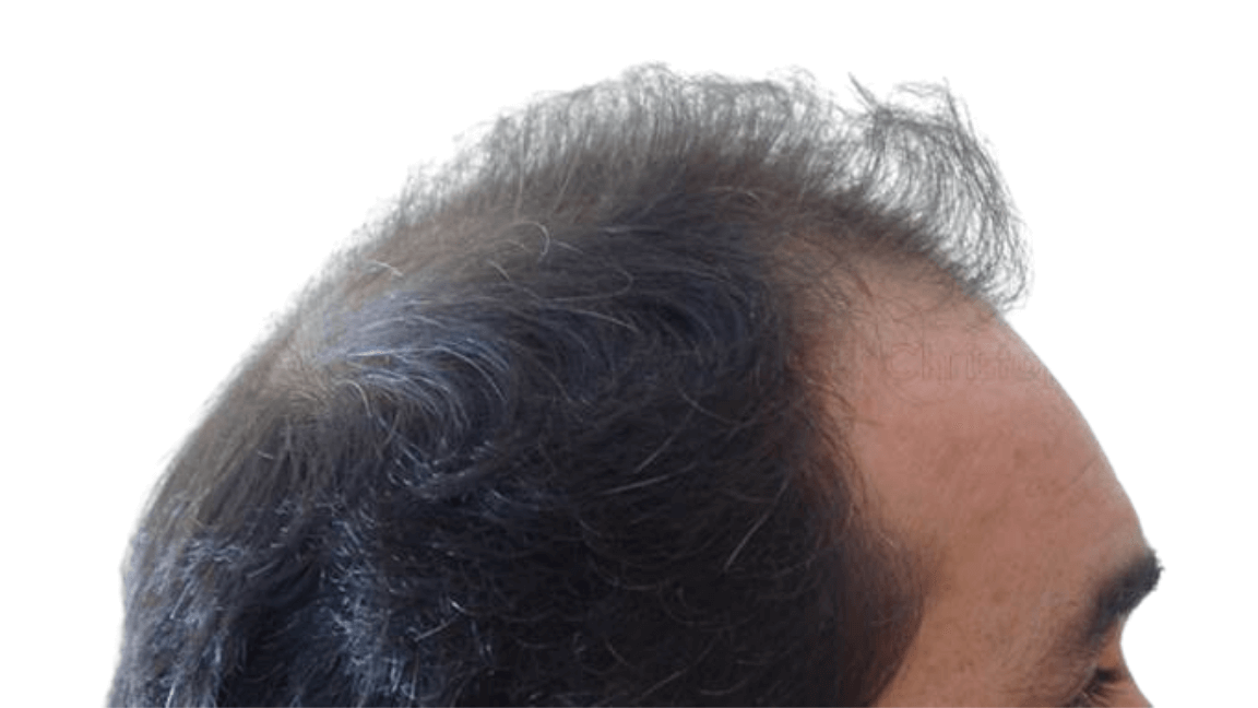 Before-Μεταμόσχευση μαλλιών