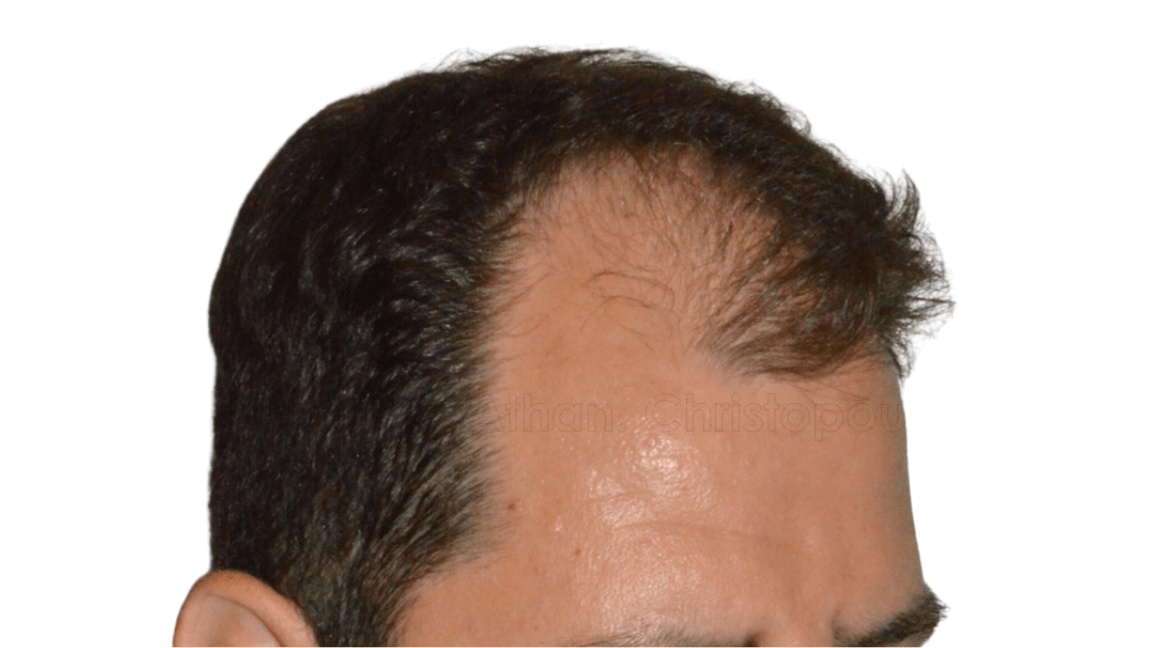 Before- Μεταμόσχευση μαλλιών